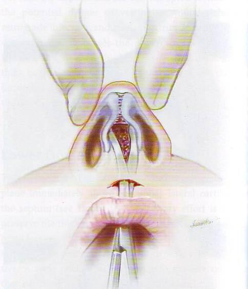 Gambar 3. Rongga columellar diseksi selebar-lebarnya 3. Tip diseksi Diseksi dilakukan antara kartilago lateral bawah.