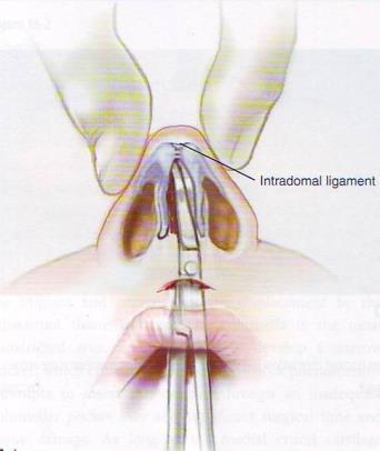 Diseksi dorsal Diseksi pada bidang jaringan tepat di atas kartilago lateral atas dan septum. Setiap upaya adalah untuk mempertahankan ketebalan jaringan lunak dorsal hidung. 5.