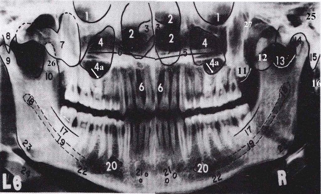 Gambar 1. Struktur anatomi pada radiografi panoramik 2 Keterangan : 1. Rongga orbita, 2. Rongga hidung, 3. Septum nasi, 4. Sinus maksilaris, 4a. Dinding sinus maksilaris 5.Prosesus palatinus, 6.