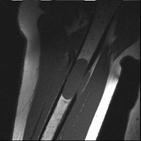 interocanter. Lesi-lesi lebih kecil tampak pada trocanter mayor.(dikutip dari kepustakaan 9) 2) CT-Scan CT Scan menggambarkan keterlibatan tulang pada myeloma.