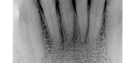 Proses seleksi ROI pada tulang trabekula regio anterior mandibula (A), dan hasil crop ROI (B) Proses seleksi ROI dilakukan dengan validasi dokter gigi yang berkompeten dalam bidang radiologi