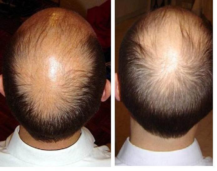 Penyebab Rambut Rontok Beberapa penyebab rambut rontok yang harus anda ketahui diantaranya : 1. Disebabkan oleh penyakit atau suatu kondisi medis.