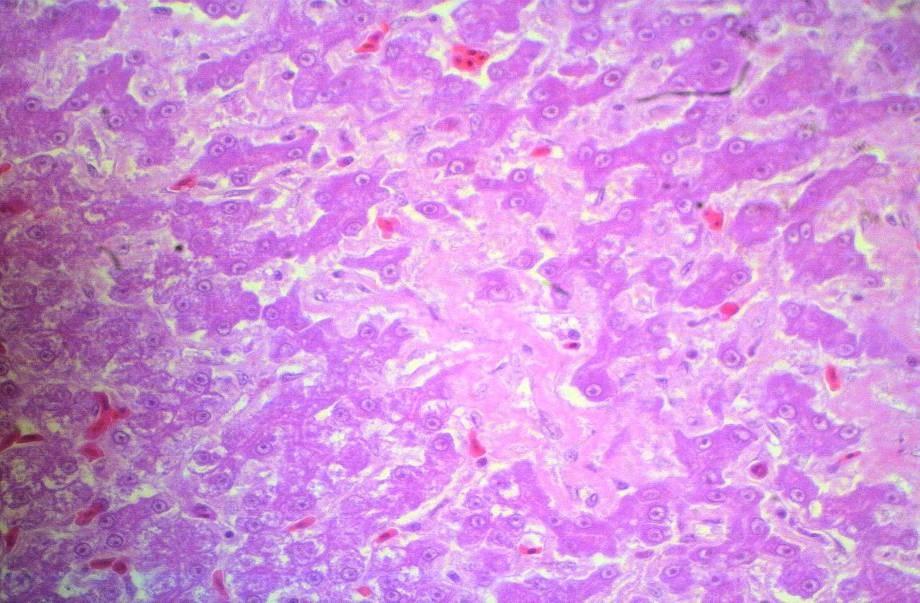 87 Gambar 19 Sirosis hati dengan pembentukan jaringan ikat diantara hepatosit. Perbesaran objective 40x HE.