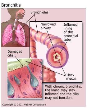 Bronkitis kronis adalah suatu penyakit yang ditandai dengan batuk dan berlebihan sekresi lendir di pohon tracheobronchial.