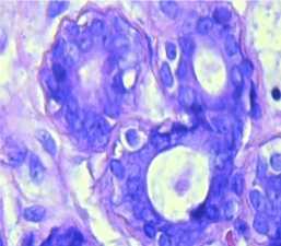 sel kanker dibentuk dari sel-sel normal dalam suatu proses rumit yang disebut transformasi, yang terdiri dari tahap insiasi dan promosi (Desen, 2008). Histologi ductus mammae ( A.