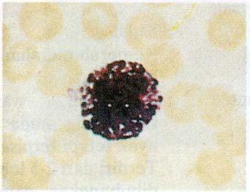 3.1.3 Netrofil Sel sel ini di sebut lekosit polimorfonuklear karena bentuk intinya bermacam macam. Ada dua jenis netrofil yaitu netrofil batang dan netrofil segment.