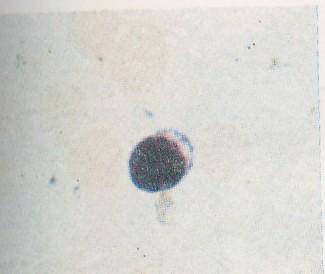 banyak di banding limfosit kecil, berwarna biru muda dan dapat mengandung granula azurofil yang berwarna merah. ( Anonim ). 3.2.