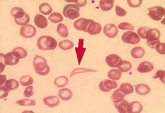 Berwarna lebih padat daripada eritrosit biasa. Didapat pada anemia hemolitik sel sabit. Gambar 2.7 Sickle 9.