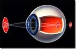 lensa cekung, maka harga Si adalah negatif. Dari persamaan lensa tipis, 1/f=1/So+1/Si, Si adalah jarak titik jauh mata miopi. So adalah jarak benda ke mata, f adalah fokus lensa kaca mata.