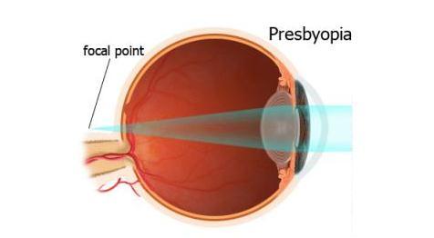 2.4 PRESBIOPIA 2.4.1 Definisi Makin berkurangnya kemampuan akomodasi mata sesuai dengan makin meningkatnya umur.