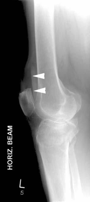 Robekan ligamen kollateral medial dan meniscus medial sering menyertai fraktur kondiler lateral. Fraktur kondiler medial disertai robekan ligamen kollateral lateral dan meniskus medial.