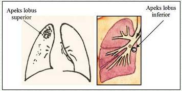 22 Pada kasus limfadenitis tuberkulosis, akan dijumpai pembesaran kelenjar getah bening yang umumnya di daerah leher ataupun di daerah ketiak.