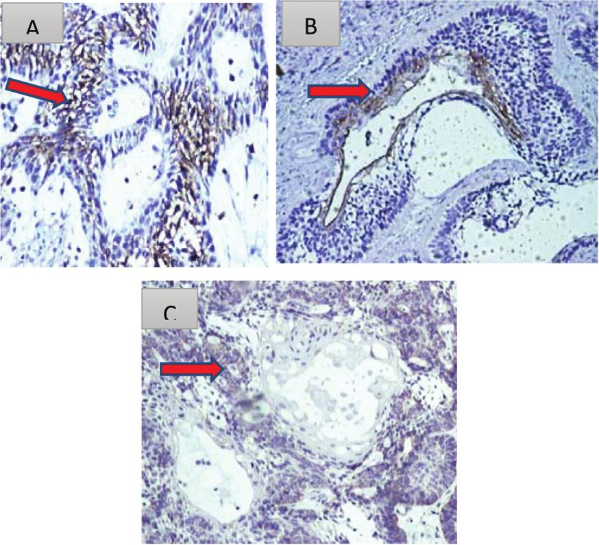 Hubungan imunoskor CD10 dan AKT dengan durasi munculnya tumor pada ameloblastoma tipe pleksiform, folikuler dan akantomatosa (Uji Korelasi Rank Spearman) Tabel 7 menunjukkan hubungan ekspresi CD10