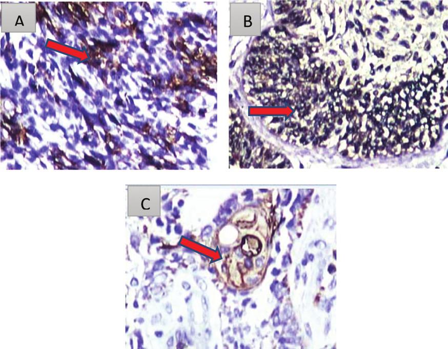Foto hasil penelitian pada ameloblastoma tiga tipe histopatologis dengan pewarnaan IHC CD10, x100,ekspresi positif CD10 pada sitoplasma dan membran sel basal dari ameloblastoma, A. tipe pleksiform; B.