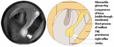 20 BAB 2 TINJAUAN KEPUSTAKAAN 2.1. Anatomi telinga tengah Telinga tengah terdiri dari membran timpani, kavum timpani, tuba Eustachius dan prosessus mastoideus (Dhingra, 2007). 2.1.1. Membran Timpani Membran timpani dibentuk dari dinding lateral kavum timpani yang memisahkan liang telinga luar dari kavum timpani.