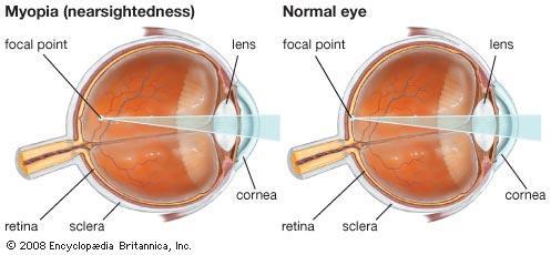 20 mempunyai titik jauh yang terbatas untuk penglihatan jelas (Guyton & Hall, 2008). Gambar 2. Mata penderita myopia dan mata normal e.
