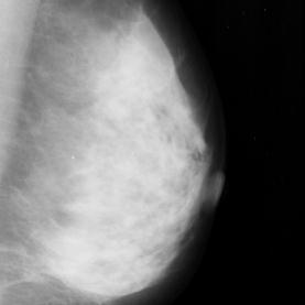 3. Pemotongan citra mammogram payudara; (a) mdb004 sebelum dipotong, (b) mdb004 setelah dipotong Dalam proses pemotongan, diusahan citra tetap berbentuk bujur sangkar sesuai dengan bentuk awal citra.