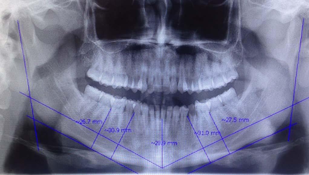 premolar kanan (Q1), distal molar kanan (R1), distal premolar kiri (Q2) dan distal molar kiri (R2),