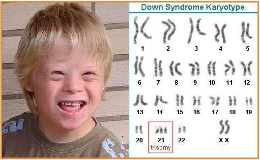 Formula kromosom sindrom down Jenis kelamin Nomenklatur kromosom Pria 47,XY+21 Wanita 47,XX+21 Gambar 6. Kariotipe syndrome down Sumber: image.google.