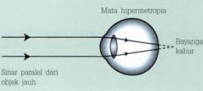 11 Gambar 2. Hipermetropia 18 2.2.3 Astigmatisma Astigmatisma adalah pembiasaan pada lebih dari satu titik fokus berkas sinar yang sejajar yang masuk ke dalam mata pada keadaan tanpa akomodasi.