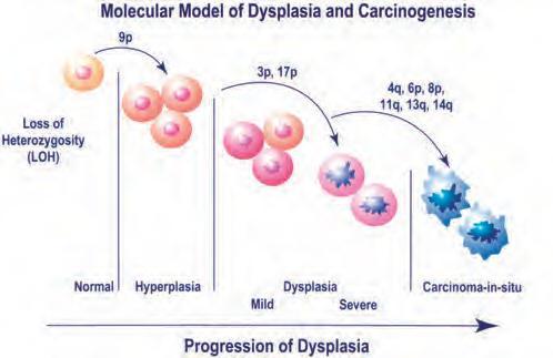 Gambar 3. Model Molekul Displasia Dan Karsinogenesis 2.1.6 Tanda dan Gejala Kanker mulutbiasanya diidentifikasi setelah perkembangan gejala penyakit terjadi pada tahap lanjut.