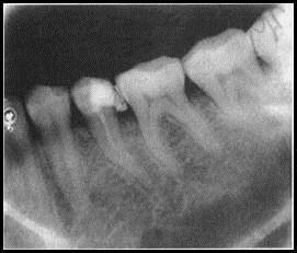 Ligamen periodontal adalah suatu ikatan, yang menghubungkan dua buah tulang. Akar gigi berhubungan dengan soketnya pada tulang alveolar melalui struktur jaringan ikat yang disebut sebagai ligamen.