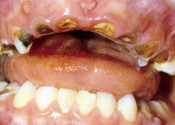 Pada tahap ini insisivus desidui maksila biasanya sudah nekrosis dan molar desidui maksila berada pada tahap tiga.