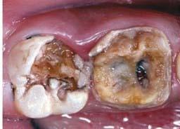 : 30 Keterlibatan Pulpa (P) Kamar pulpa yang terbuka terlihat atau ketika struktur mahkota gigi