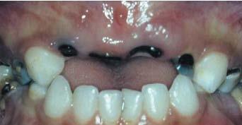 Pada stadium ini, gigi sulung anterior maksila biasanya nekrosis dan gigi molar sulung maksila berlangsung ECC stadium 3.