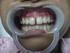 Perawatan awal penutupan diastema gigi goyang pada penderita periodontitis kronis dewasa