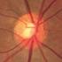 NORMAL TENSION GLAUCOMA (NTG)