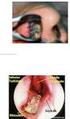 BAB II TINJAUAN PUSTAKA. anterior hingga koana di posterior yang memisahkan rongga hidung dari nasofaring.