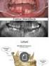 Fraktur angulus mandibula sebagai komplikasi tindakan pencabutan molar ketiga rahang bawah