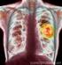 Peranan Radiologi Intervensi Pada Kanker Paru. Kanker merupakan masalah kesehatan di seluruh dunia. Menurut World Health