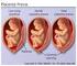 1. Pengertian Plasenta previa merupakan plasenta yang letaknya abnormal yaitu pada segmen bawah rahim sehingga menutupi sebagian atau seluruh