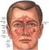 Anatomi Sinus Paranasal Ada empat pasang sinus paranasal yaitu sinus maksila, sinus frontal, sinus etmoid dan sinus sfenoid kanan dan kiri.