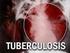 BAB II KAJIAN PUSTAKA. paru,tetapi juga dapat mengenai organ tubuh lainnya. Kuman Mycobacterium
