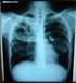 Risk Factors for Recurrences of Pulmonary TB among Patients in Denpasar: A Case-Control Study