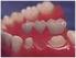Desain preparasi gigitiruan cekat mempengaruhi kesehatan jaringan periodontal