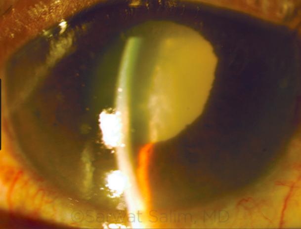 probabilitatea pierderii vederii la glaucom