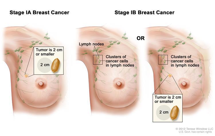 Ciri kanker payudara stadium awal sampai akhir