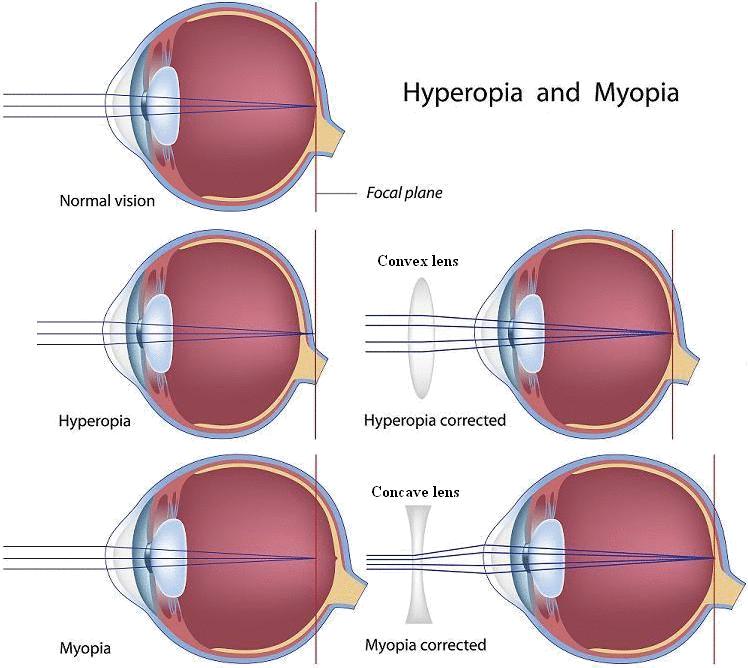 myopia hyperopia kép)