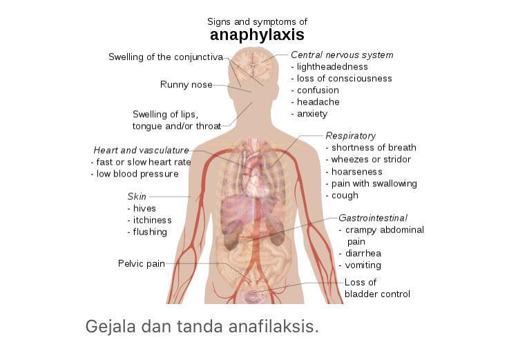 Adalah anafilaksis Anafilaksis: Rangkuman