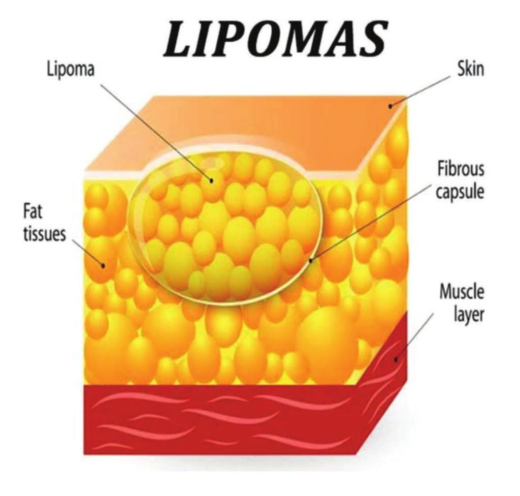 Lipoma ini tidak merbahaya dan kebiasannya tidak berkanser. Memang jarang untuk lipoma ini menjadi kanser tetapi ia boleh berlaku dalam peratusan yang kecil seperti liposarcoma.