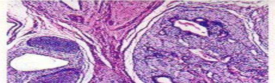 dengan lapisan sel germinal, dan semua teratoma testis dewasa dipandang ganas. Gambar 7. Teratoma: A. makroskopis, B.