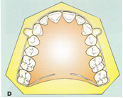 baru setelah semua gigi digerakkan antara lain: a. Retainer harus dapat memberikan akses kepada tekanan fungsional untuk dapat be