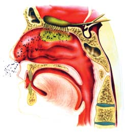 Tuli dapat disebabkan oleh kotoran yang menyumbat saluran telinga. Selain itu, tuli dapat disebabkan oleh kerusakan pada bagian dalam telinga.