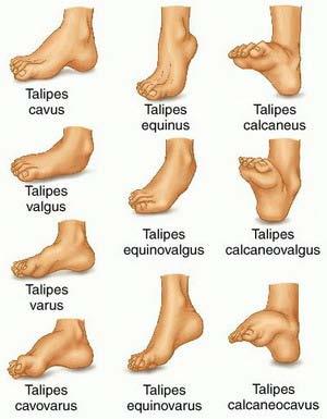 2.5.1. Kelainan pada Telapak Kaki Kelainan bentuk pada telapak kaki bisa berupa kelainan kongenital, akibat penyakit sistemik, atau akibat kecelakaan yang menyebabkan terjadinya deformitas.
