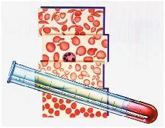 THALASEMIA A. DEFINISI Thalasemia adalah penyakit kelainan darah yang ditandai dengan kondisi sel darah merah mudah rusak atau umurnya lebih pendek dari sel darah normal (120 hari).