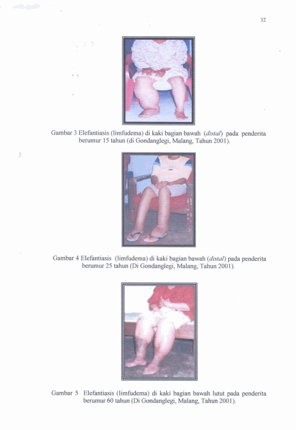 Gambar 3 Elefantiasis (limfbdema) di kaki bean bad (disral) pda penderita be~mur 15 tahun (di Gondanglegi, Malang, Tahun 2001).